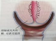 宮頸癌篩查沒那么簡(jiǎn)單，這些技巧助你提高取樣質(zhì)量